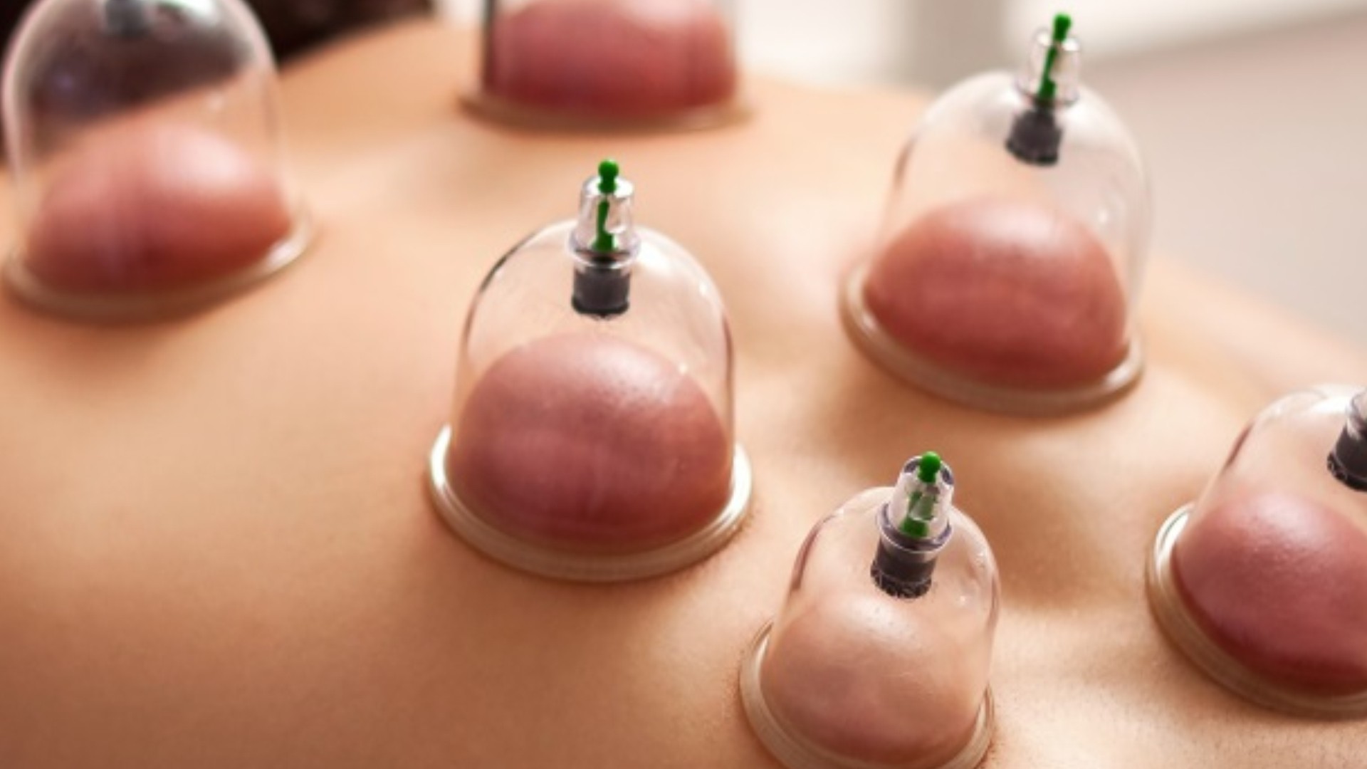 Free Hijama Camps